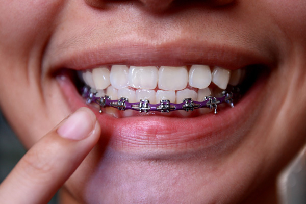 Orthodontic-treatment