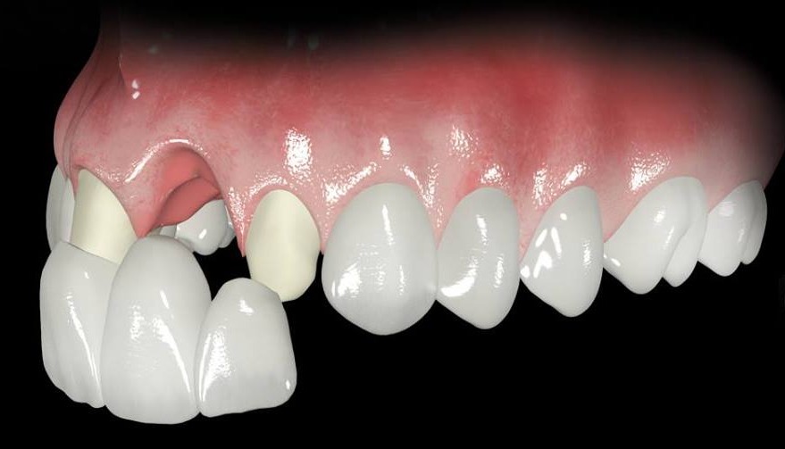 Fixed partial denture(FPD)