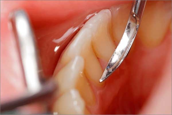 scaling and polishing of teeth