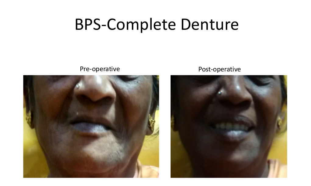 BPS-complete-denture