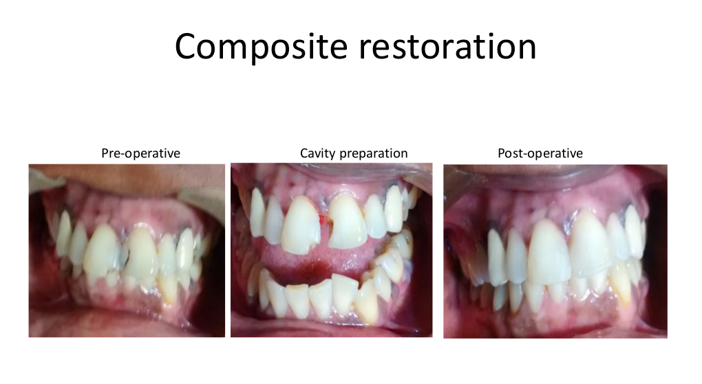 Composite-restorarion