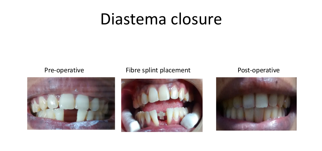 Diastema-closure