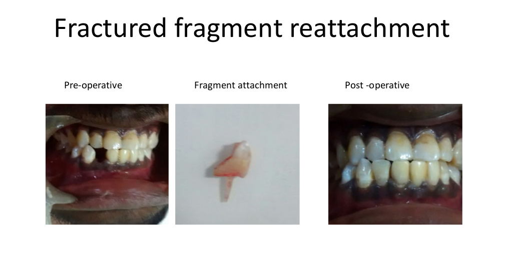 Fractured-Fragment-Reattachment