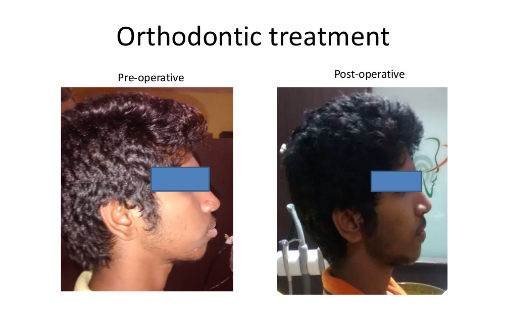 Orthodontic-Treatment