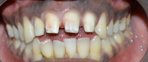 esthetic crowns