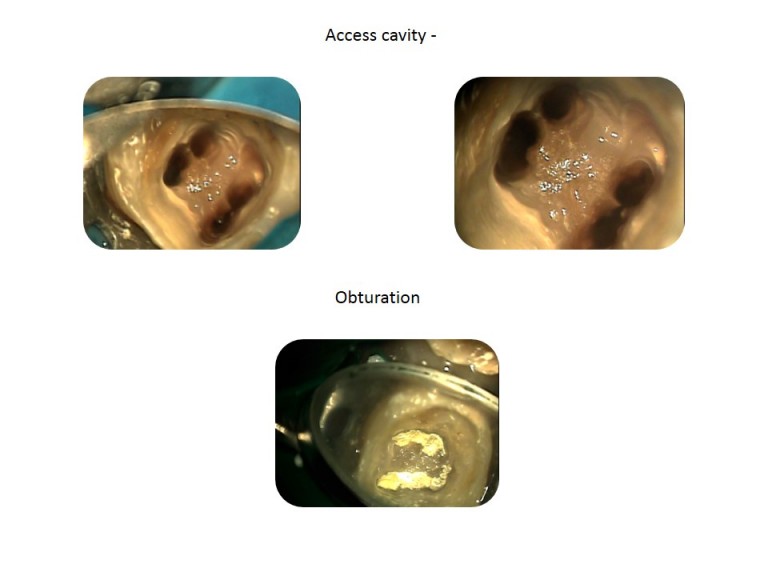 root canal treatment