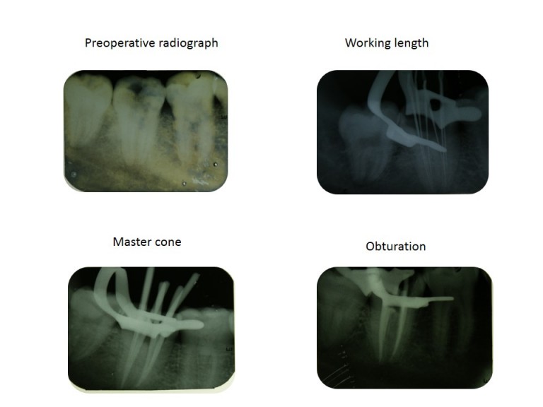 root canal treatment