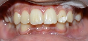 esthetic tooth filling