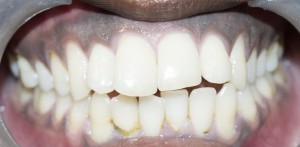 esthetic crowns