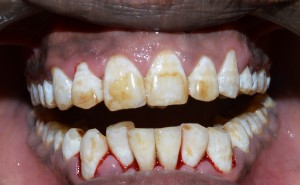 teeth scaling and polishing