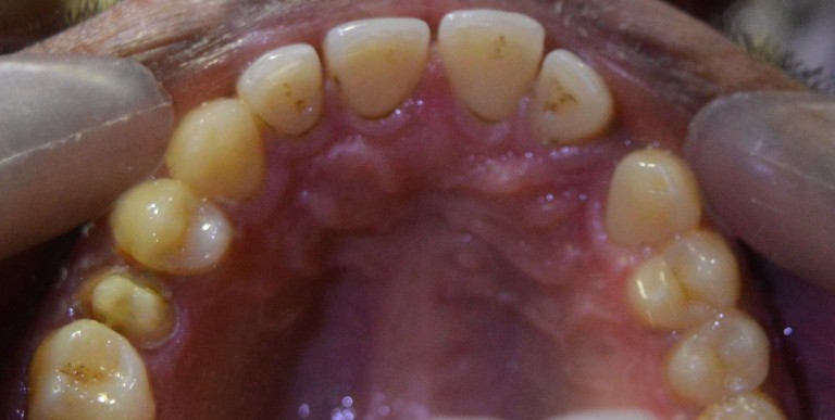 dental crown restoration procedure
