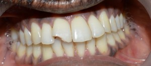 esthetic tooth filling