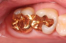 gold dental restorations