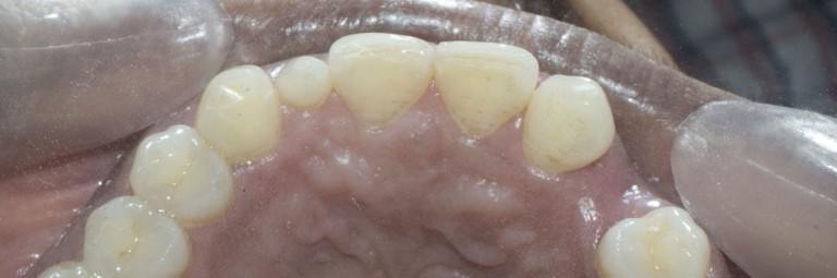 dental bridge for front teeth