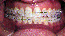 orthodontic treatment