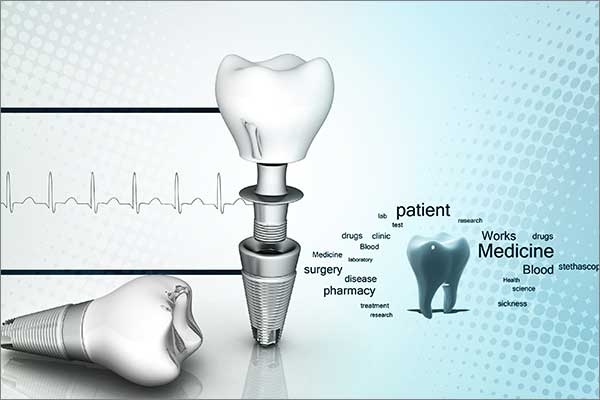 Dental implants