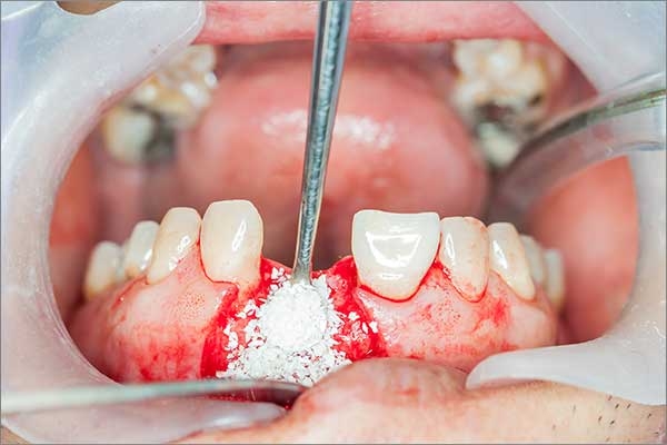 bone graft