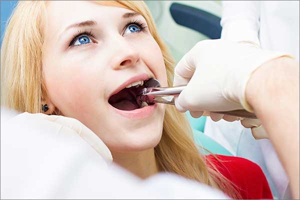 dental extractions