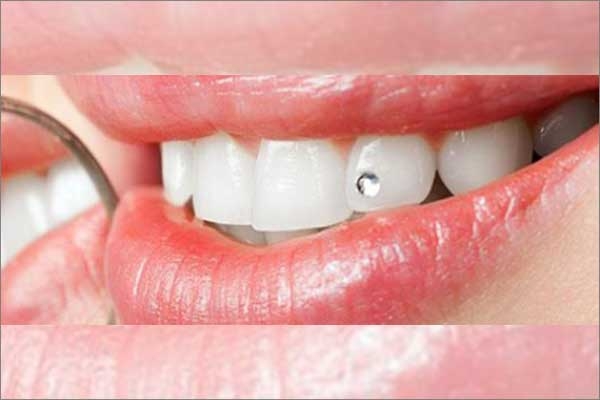 dental jewellery