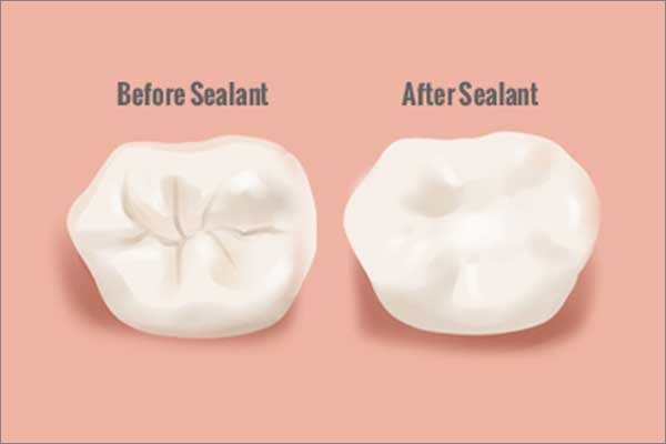 dental sealants