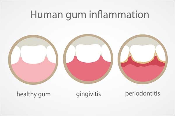 inflamed gums