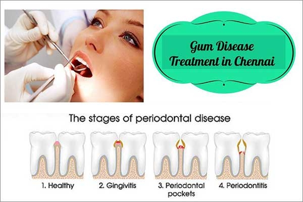 gum swelling