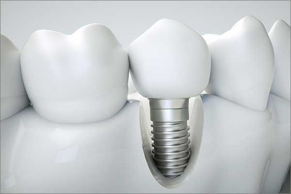 denture implants