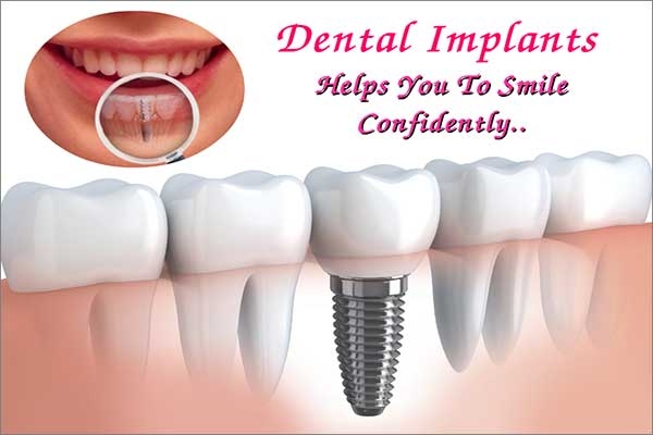dental implants benefit