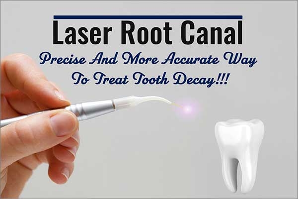 laser root canal treatment