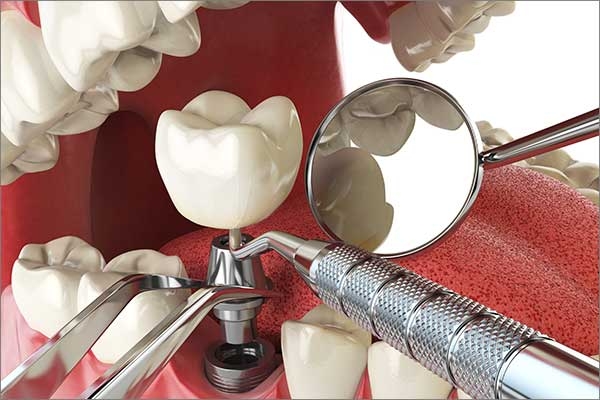 single tooth implants