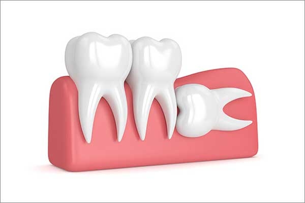 problem with wisdom tooth