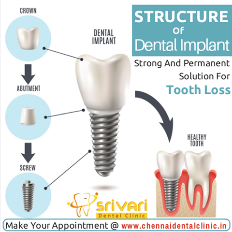 dental implants