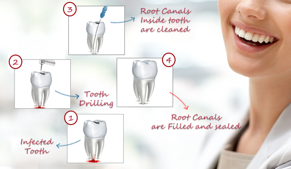 root canal treatment