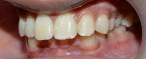 esthetic tooth filling