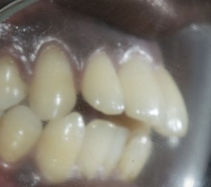 esthetic crowns