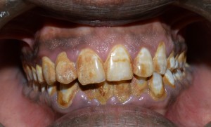 scaling and polishing of the teeth