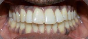 esthetic tooth filling