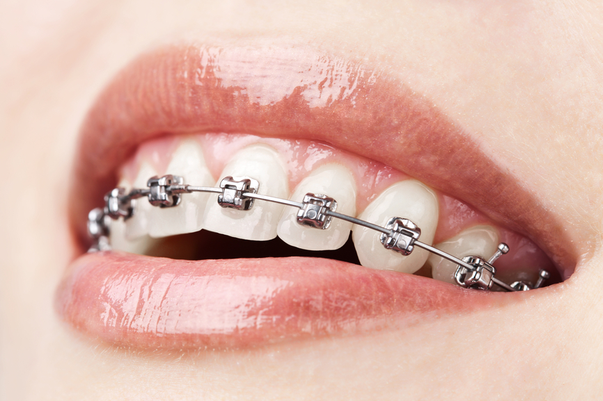 orthodontic treatment