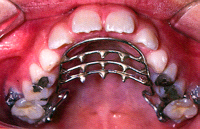 orthodontic treatment