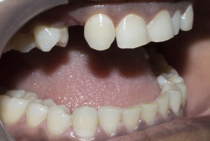 dental bridge for front teeth