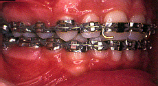 orthodontic treatment