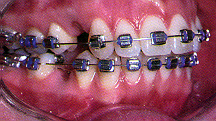 orthodontic treatment