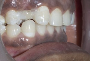 dental bridge for front teeth