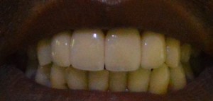 esthetic crowns