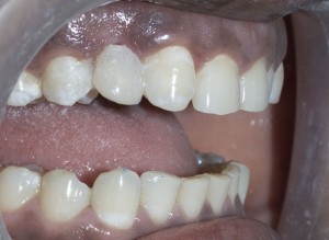 dental bridge for front teeth