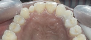 dental bridge for front teeth