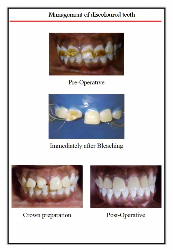 bleaching in teeth